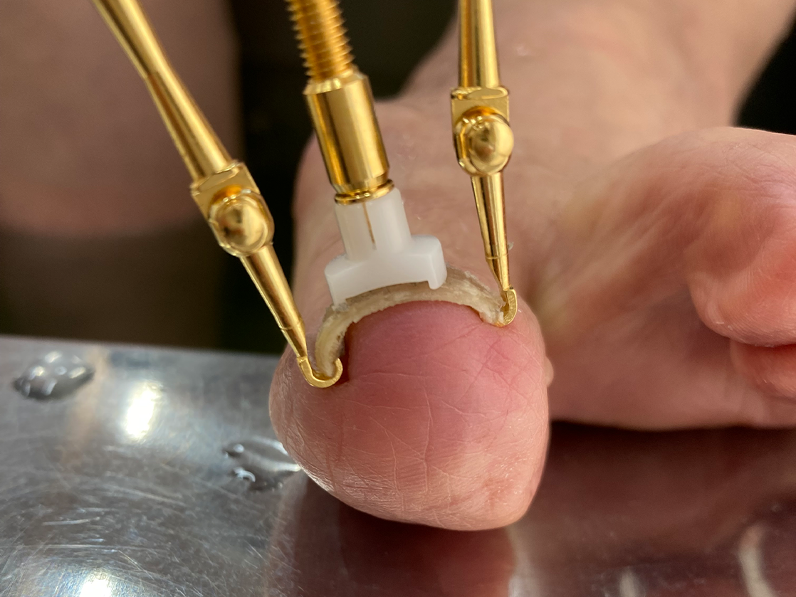 変形した爪の矯正用専用器具とテーピングによる施術例
