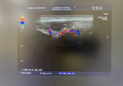 原因不明の関節の痛み。突然の手首や肘、膝関節の発赤を伴う痛み。CPPDでは。