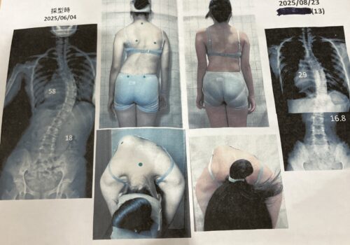 側弯症におすすめ　シュロス法　ゲンシンゲン装具の可能性